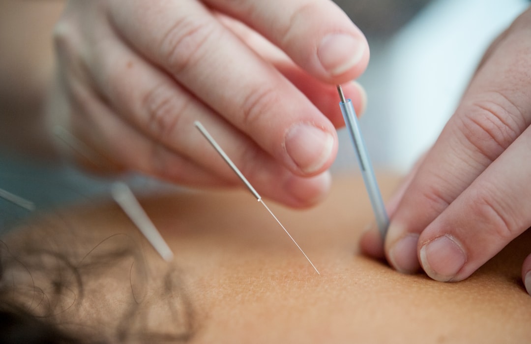 acupuncture needles inserted into skin